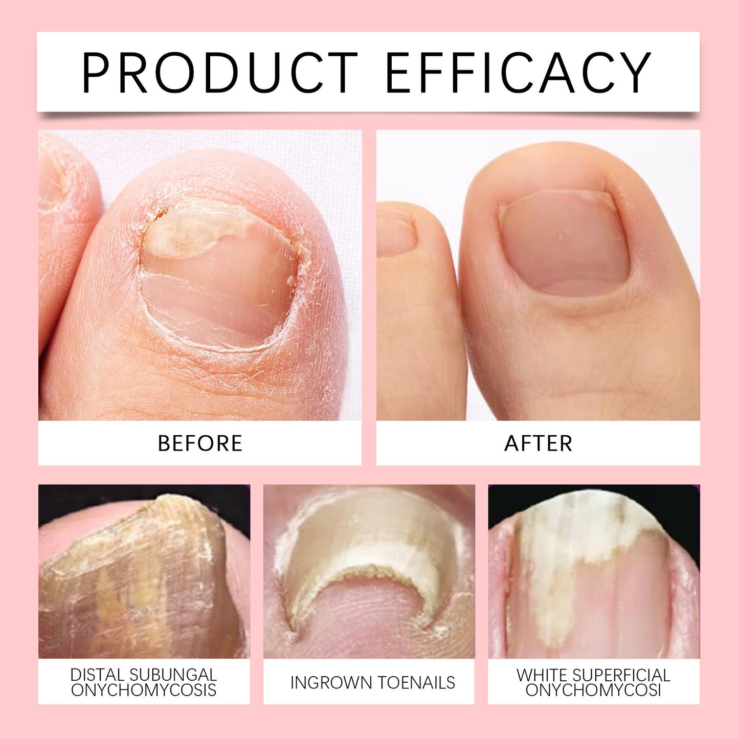 OUHOE Onychomycosis Repair Liquid Foot Care Moisturizing Cleansing Anti-Barb Onychomycosis Repair Nourishing Liquid