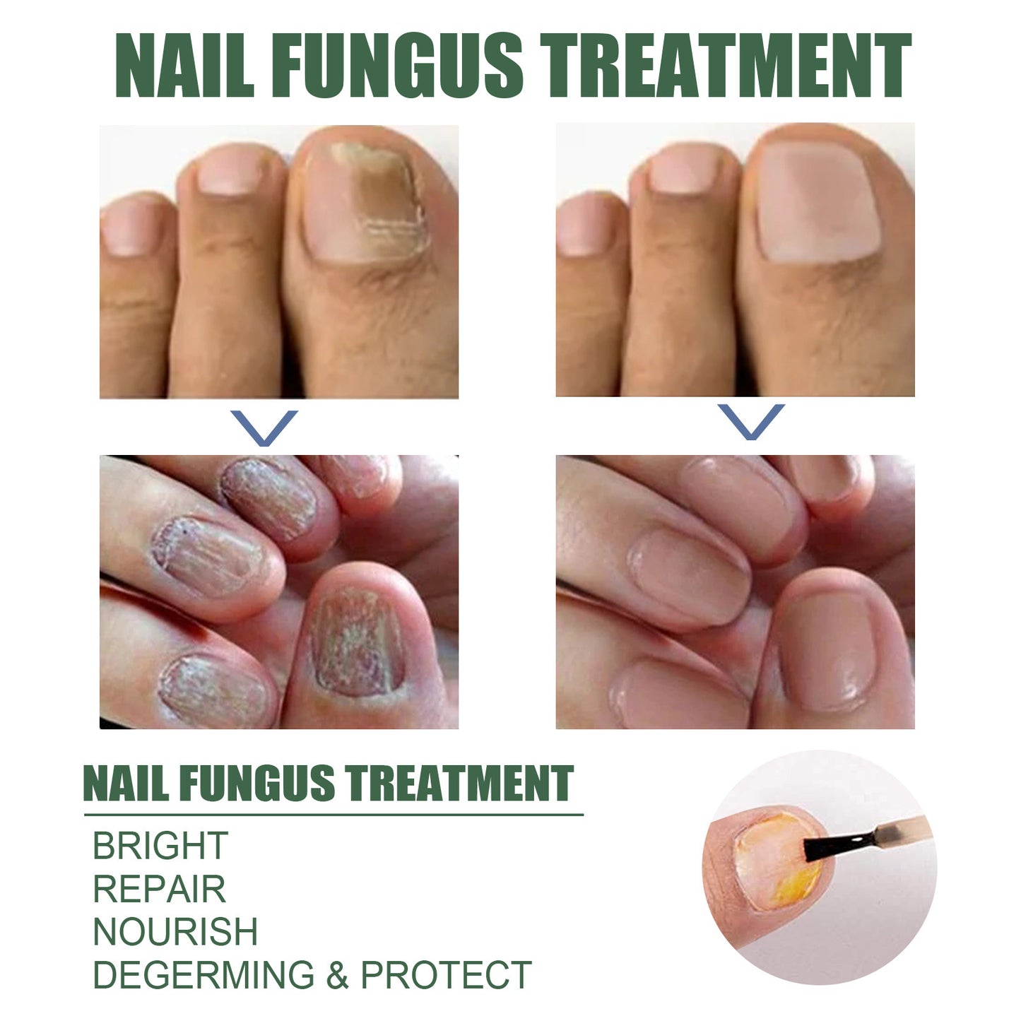 eelhoe onychomycosis repair liquid thickening and polishing soft nail liquid foot care liquid onychomycosis nail care liquid